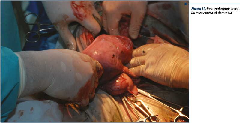 Figura 17. Reintroducerea uterului în cavitatea abdominală