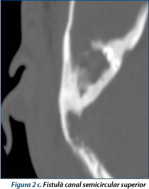 Figura 2 c. Fistulă canal semicircular superior