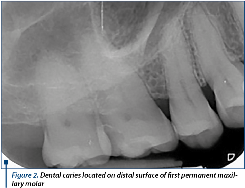 Figure 2. Dental caries located on distal surface of first permanent maxillary molar