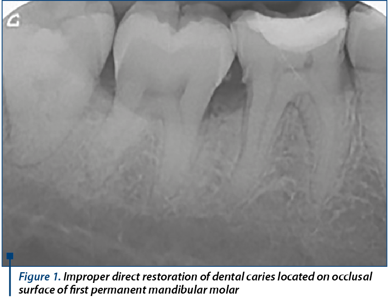 Figure 1. Improper direct restoration of dental caries located on occlusal surface of first permanent mandibular molar
