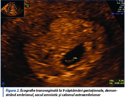 Figura 1. Ecografie transvaginală și reconstrucție tridimensională la 9 săp­tă­­mâni gestaționale, demonstrând septul uterin longitudinal incomplet (să­ge­țile albe) și sacul gestațional (săgeata albastră) localizat în partea stân­gă a uterului