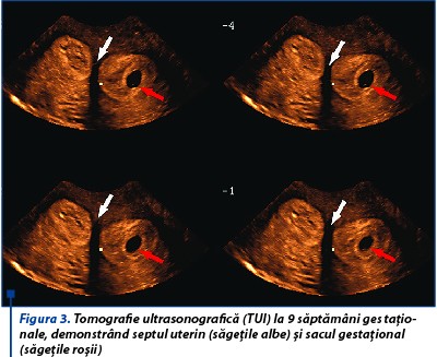 Figura 3. Tomografie ultrasonografică (TUI) la 9 săptămâni ges­ta­țio­nale, demonstrând septul uterin (săgețile albe) și sacul gestațional (săgețile roșii)