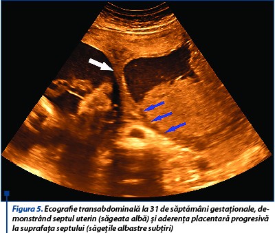 Figura 5. Ecografie transabdominală la 31 de săptămâni gestaționale, demonstrând septul uterin (săgeata albă) și aderența placentară progresivă la suprafața septului (săgețile albastre subțiri)