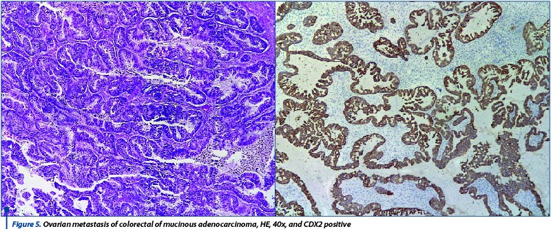 Figure 5. Ovarian metastasis of colorectal of mucinous adenocarcinoma, HE, 40x, and CDX2 positive