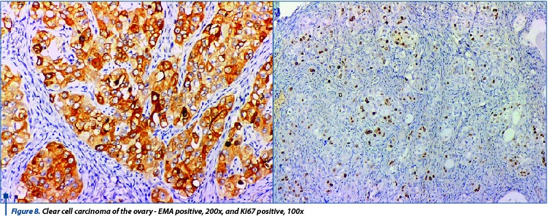 Figure 8. Clear cell carcinoma of the ovary - EMA positive, 200x, and Ki67 positive, 100x
