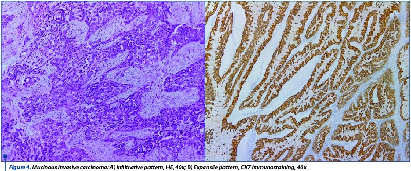 Figure 4. Mucinous invasive carcinoma: A) infiltrative pattern, HE, 40x; B) Expansile pattern, CK7 immunostaining, 40x