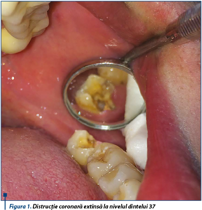 Figura 1. Distrucţie coronară extinsă la nivelul dintelui 37