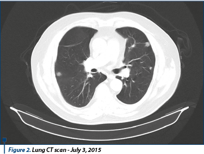 Figure 2. Lung CT scan - July 3, 2015