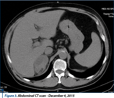 Figure 3. Abdominal CT scan - December 4, 2015