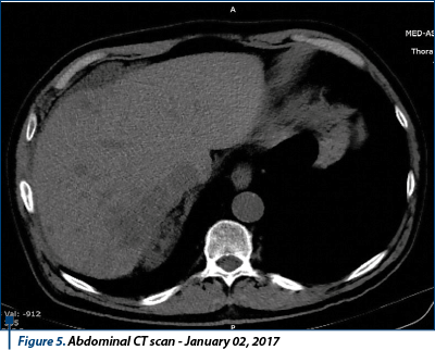 Figure 5. Abdominal CT scan - January 02, 2017
