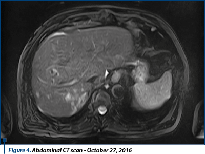 Figure 4. Abdominal CT scan - October 27, 2016