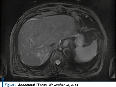 Figure 1. Abdominal CT scan - November 28, 2013