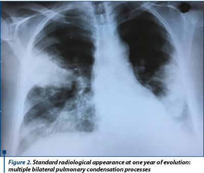 Figure 2. Standard radiological appearance at one year of evolution: mul­tiple bilateral pulmonary condensation processes