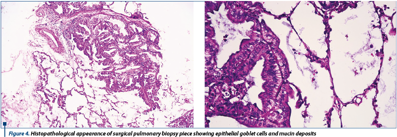 Figure 4. Histopathological appearance of surgical pulmonary biopsy piece showing epithelial goblet cells and mucin deposits