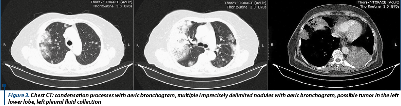 Figure 3. Chest CT: condensation processes with aeric bronchogram, multiple imprecisely delimited nodules with aeric bronchogram, possible tumor in the left lower lobe, left pleural fluid collection