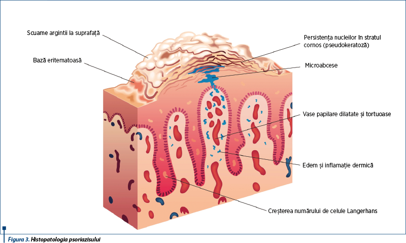 Figura 3. Histopatologia psoriazisului