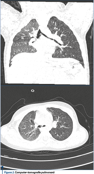 Figura 2. Computer-tomografie pulmonară