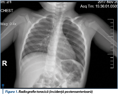 Figura 1. Radiografie toracică (incidență posteroanterioară)