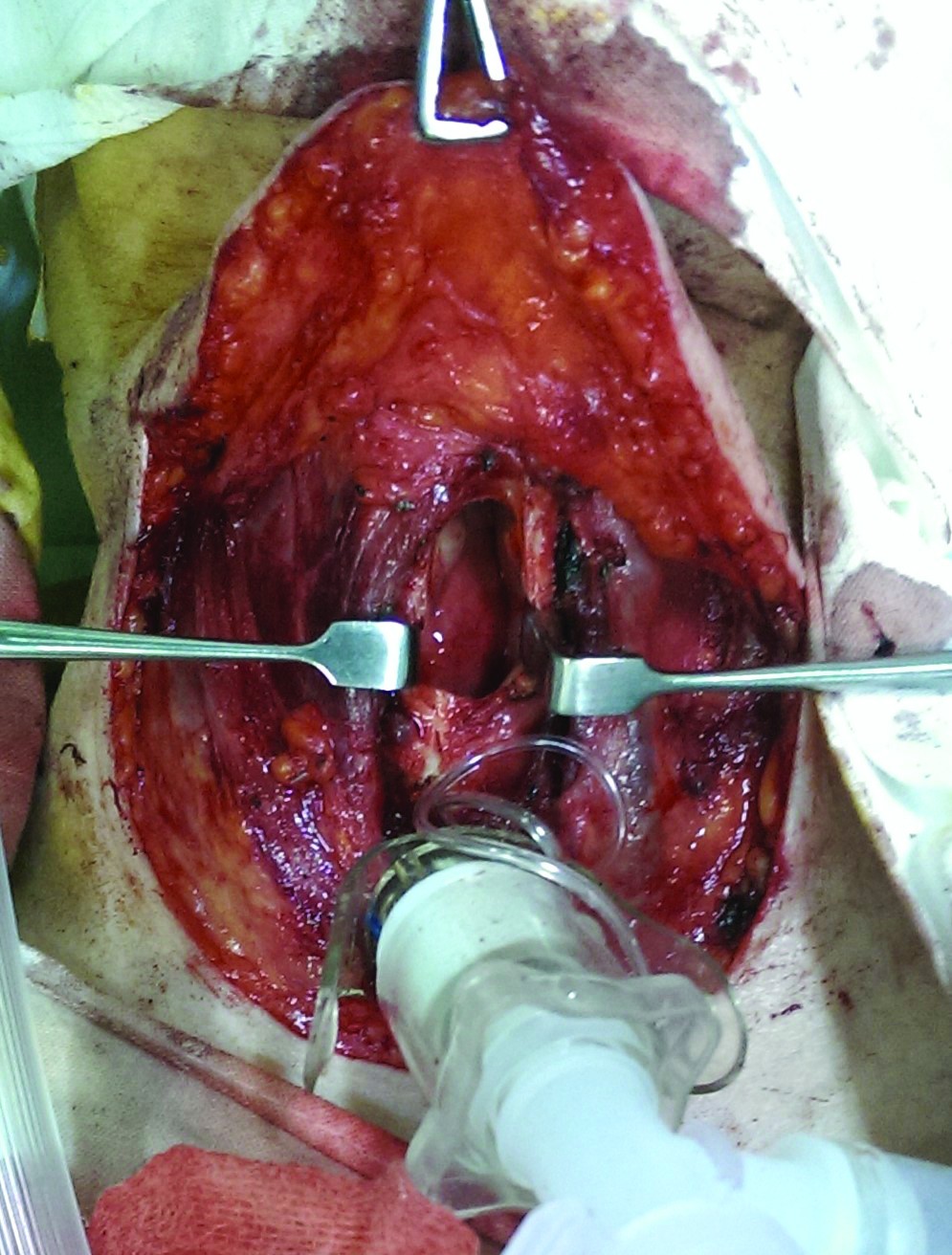 Figura 6. Aspect intraoperator după tirotomia mediană. Se observă hemilaringele drept, ocupat de formațiunea tumorală, mucoasa endolaringiană fiind de aspect normal