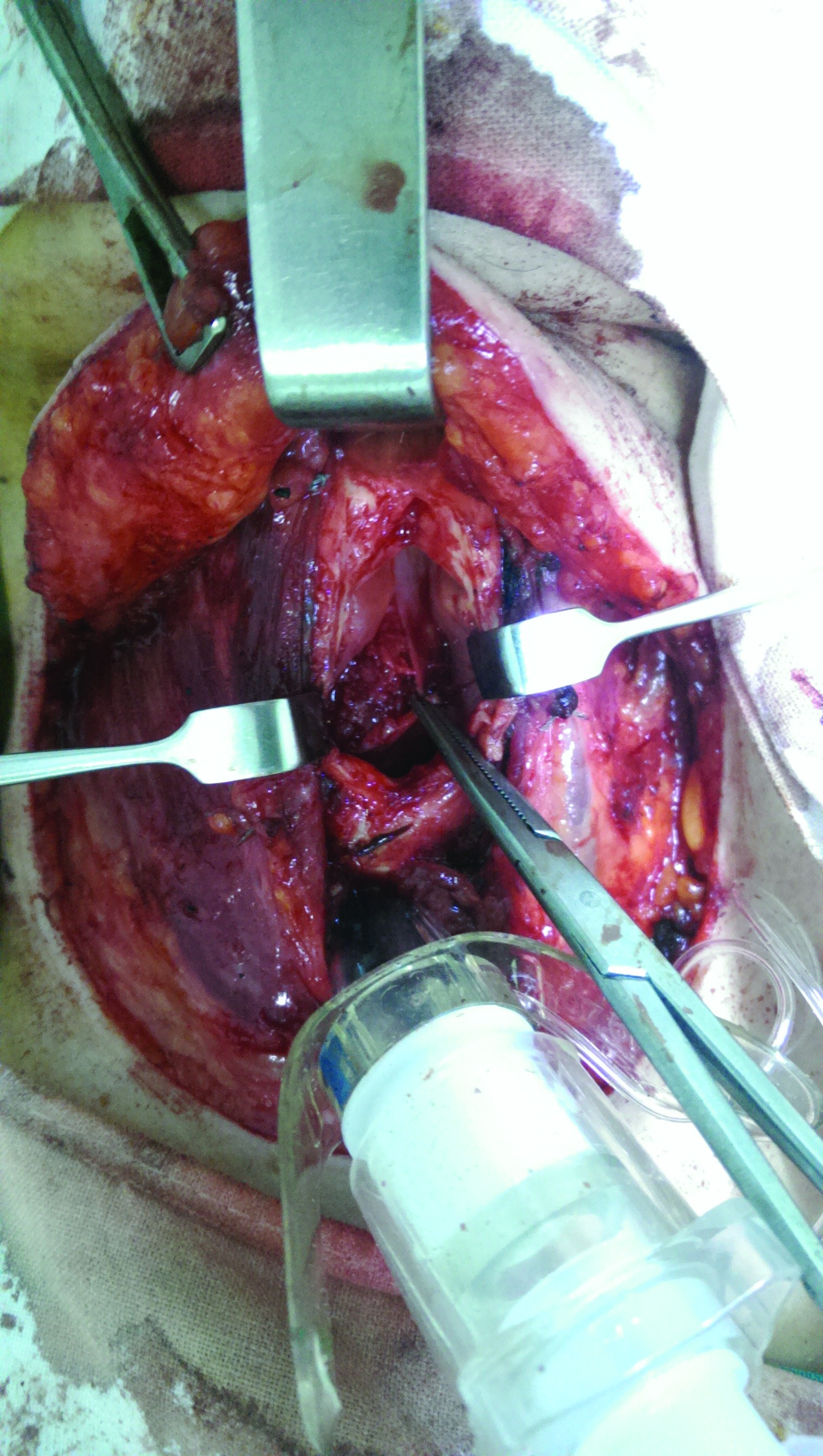 Figura 7. Aspect intraoperator după tirotomia mediană. După incizia  mucoasei în dreptul comisurii anterioare, se observă formațiunea  tumorală