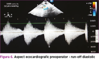 Figura 6. Aspect ecocardiografic preoperator - run-off diastolic