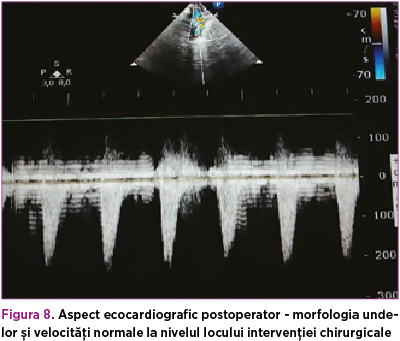 Figura 8. Aspect ecocardiografic postoperator - morfologia undelor şi velocităţi normale la nivelul 
