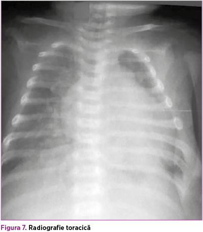 Figura 7. Radiografie toracică