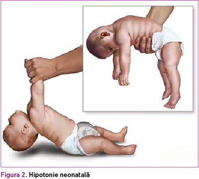 Figura 2. Hipotonie neonatală 