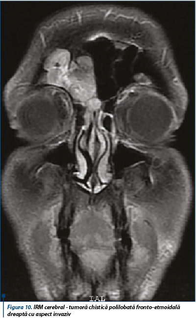 Figura 10. IRM cerebral - tumoră chistică polilobată fronto-etmoidală dreaptă cu aspect invaziv