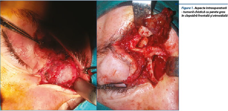 Figura 11. Aspecte intraoperatorii  - tumoră chistică cu perete gros  în clepsidră frontală şi etmoidală