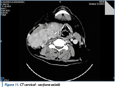 Figura 11. CT cervical - secțiune axială