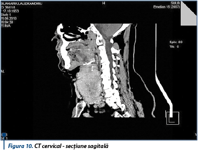 Figura 10. CT cervical - secțiune sagitală