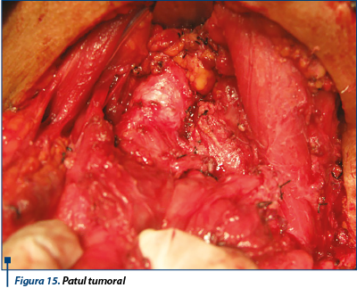 Figura 15. Patul tumoral