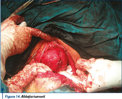 Figura 14. Ablația tumorii