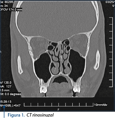 Figura 1. CT rinosinuzal