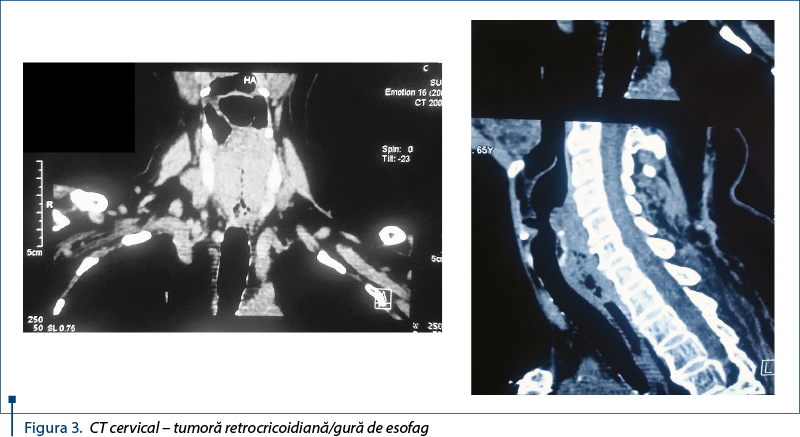 Figura 3. CT cervical – tumoră retrocricoidiană/gură de esofag