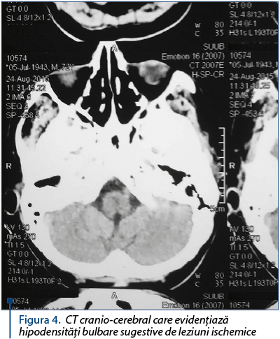 Figura 4. CT cranio-cerebral care evidenţiază hipodensităţi bulbare sugestive de leziuni ischemice