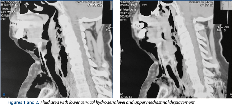 Figures 1 and 2. Fluid area with lower cervical hydroaeric level and upper mediastinal displacement