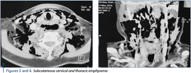 Figures 3 and 4. Subcutaneous cervical and thoracic emphysema