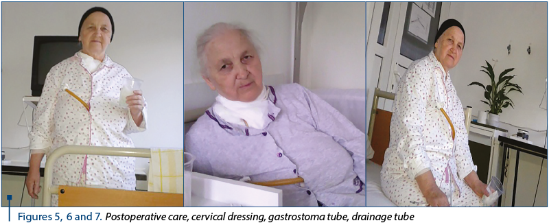 Figures 5, 6 and 7. Postoperative care, cervical dressing, gastrostoma tube, drainage tube