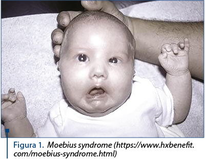 Figura 1. Moebius syndrome (https://www.hxbenefit.com/moebius-syndrome.html)