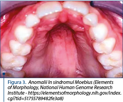 Figura 3. Anomalii în sindromul Moebius (Elements of Morphology, National Human Genome Research Institute - https://elementsofmorphology.nih.gov/index.cgi?tid=51755789482fe3a8)