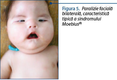 Figura 5. Paralizie facială bilaterală, caracteristică tipică a sindromului Moebius(8)