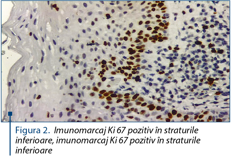 Figura 2. Imunomarcaj Ki 67 pozitiv în straturile inferioare, imunomarcaj Ki 67 pozitiv în straturile inferioare