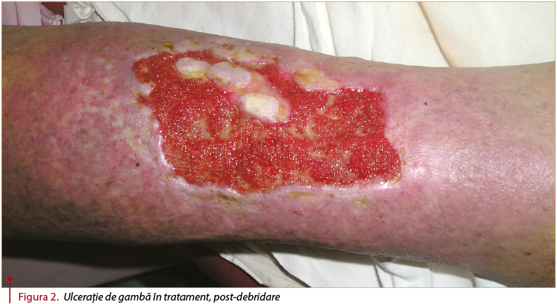 Figura 2. Ulceraţie de gambă în tratament, post-debridare