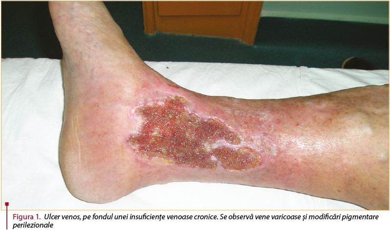 Figura 1. Ulcer venos, pe fondul unei insuficienţe venoase cronice. Se observă vene varicoase şi modificări pigmentare perilezionale