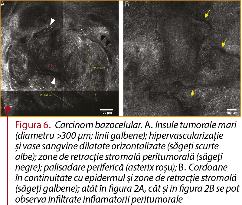 Figura 6. Carcinom bazocelular. A. Insule tumorale mari (diametru >300 µm; linii galbene); hipervascularizaţie şi vase sangvine dilatate orizontalizate (săgeţi scurte albe); zone de retracţie stromală peritumorală (săgeţi negre); palisadare periferică (asterix roşu); B. Cordoane în continuitate cu epidermul şi zone de retracţie stromală (săgeţi galbene); atât în figura 2A, cât şi în figura 2B se pot observa infiltrate inflamatorii peritumorale