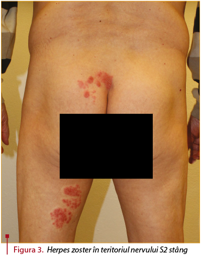 tratamentul lipelurilor în vene varicoase ale extremităților inferioare
