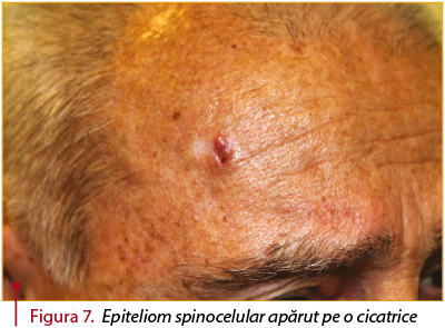 Figura 7. Epiteliom spinocelular apărut pe o cicatrice