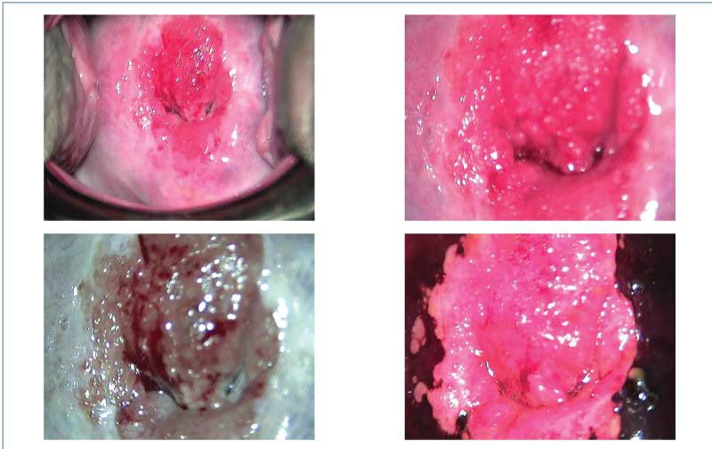 Figura 2. Infecţie cu HPV şi sarcină la 16 sg -  epiteliu aceto-alb, mozaic fin, punctaţie, zone iod-negative. CIN 1 (dificil de diferenţiat de metaplazia imatură)